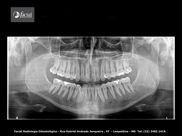 Radiografia Panoramica