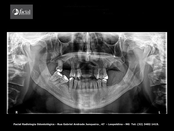 Radiografia Panoramica
