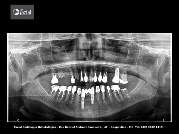 Radiografia Panorâmica
