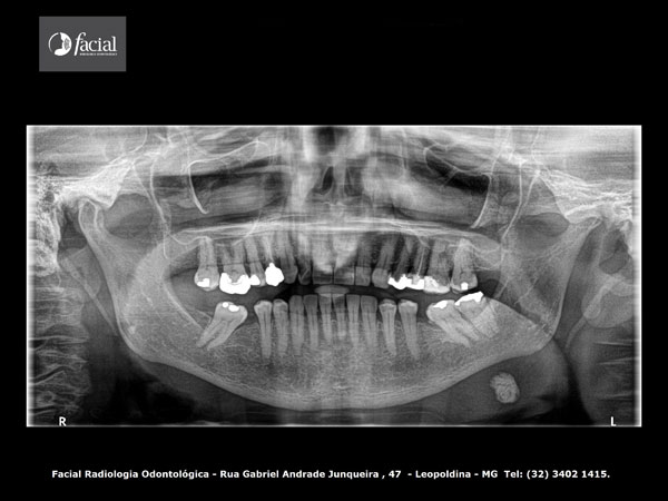 Radiografia Panorâmica
